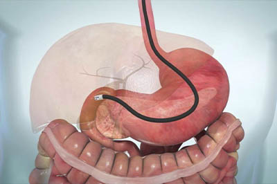 GI Endoscopy
