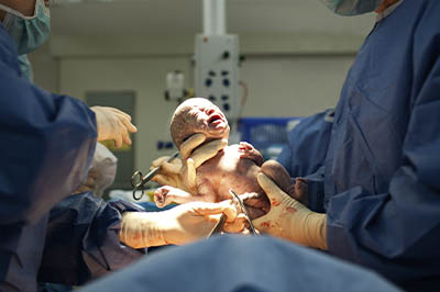 Delivery / C Section